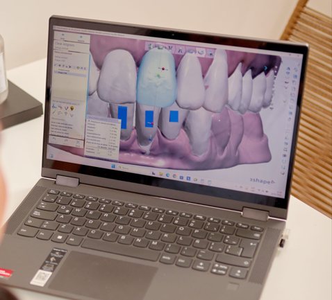Caso en planificación en 3Shape Ortho System